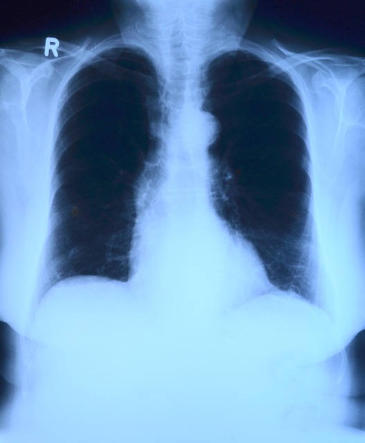 Chest X-ray